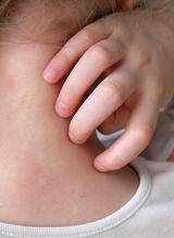 Forstå de forskjellige stadiene av skabb